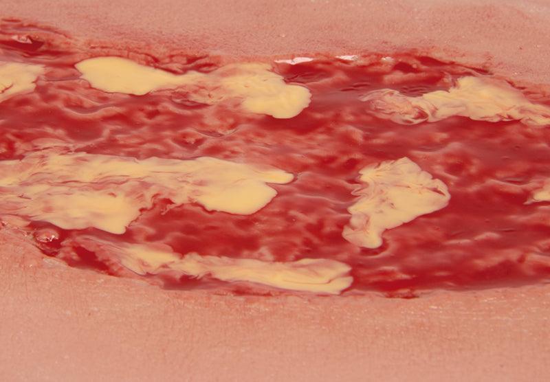 Wundmoulage Ulcus Cruris Venosum, groß, Exsudationsphase, PW003A - Notemed Medizintechnik 