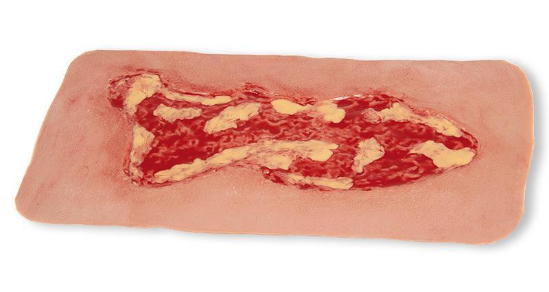 Wundmoulage Ulcus Cruris Venosum, groß, Exsudationsphase, PW003A - Notemed Medizintechnik 