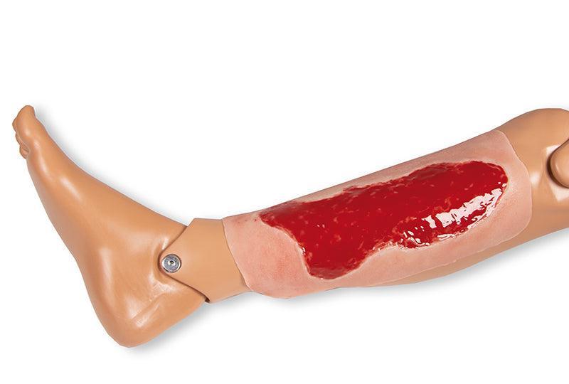 Wundmoulage Ulcus Cruris Venosum, groß, Granulationsphase, PW003B - Notemed Medizintechnik 