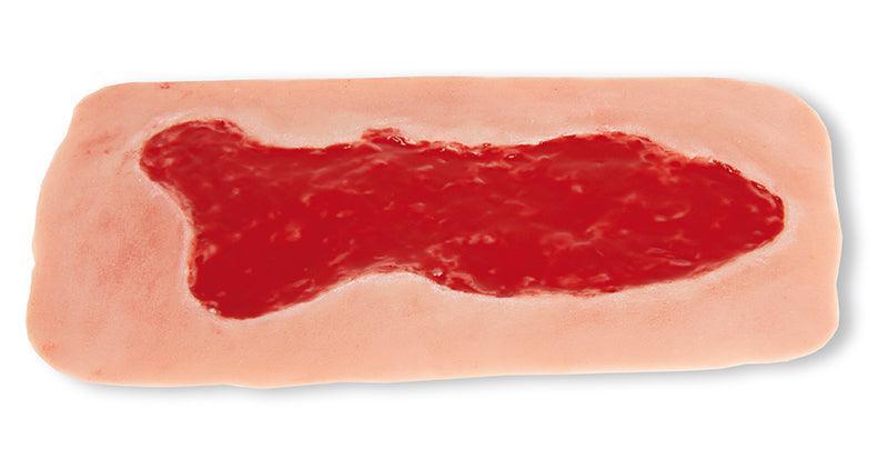 Wundmoulage Ulcus Cruris Venosum, groß, Granulationsphase, PW003B - Notemed Medizintechnik 