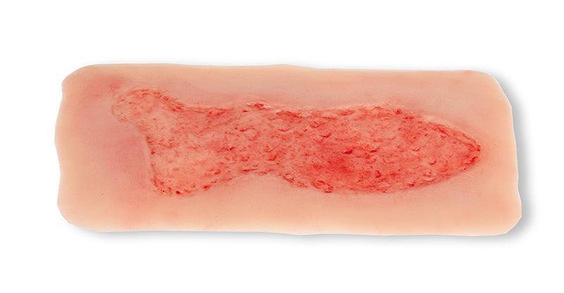 Wundmoulage Ulcus Cruris Venosum, groß, Epithelisierungsphase, PW003C - Notemed Medizintechnik 