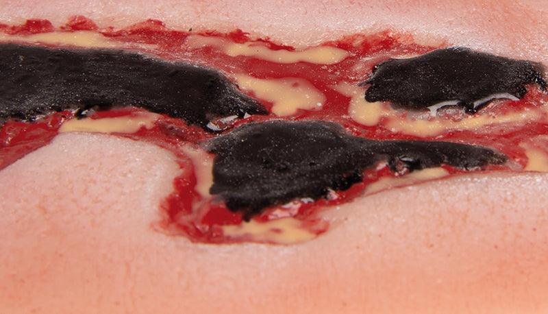 Wundmoulage Ulcus Cruris Arteriosum, klein, Exsudationsphase, PW004A - Notemed Medizintechnik 