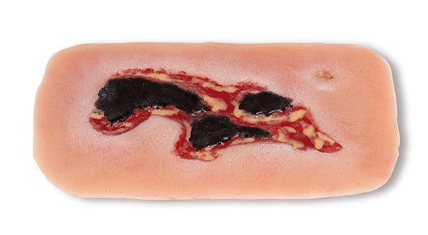 Wundmoulage Ulcus Cruris Arteriosum, klein, Exsudationsphase, PW004A - Notemed Medizintechnik 