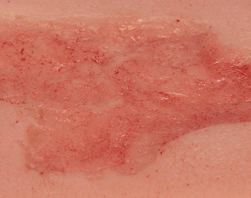 Wundmoulage Ulcus Cruris Arteriosum, klein, Epithelisierungsphase, PW004C - Notemed Medizintechnik 
