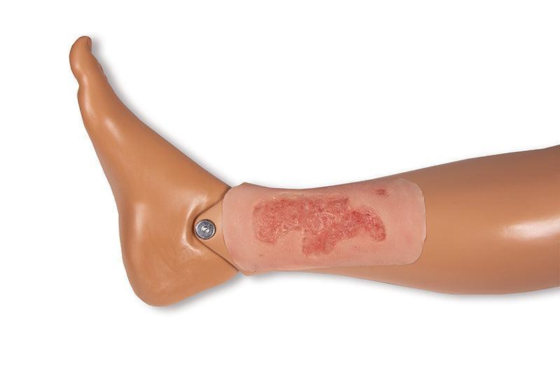 Wundmoulage Ulcus Cruris Arteriosum, klein, Epithelisierungsphase, PW004C - Notemed Medizintechnik 