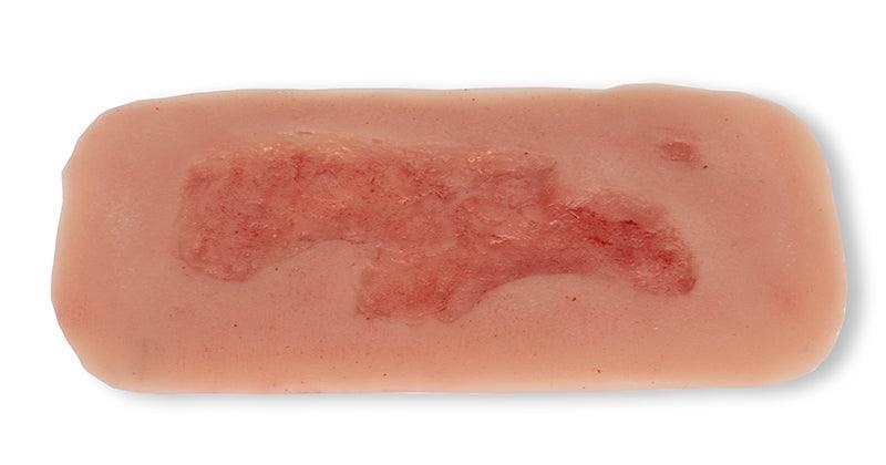 Wundmoulage Ulcus Cruris Arteriosum, klein, Epithelisierungsphase, PW004C - Notemed Medizintechnik 