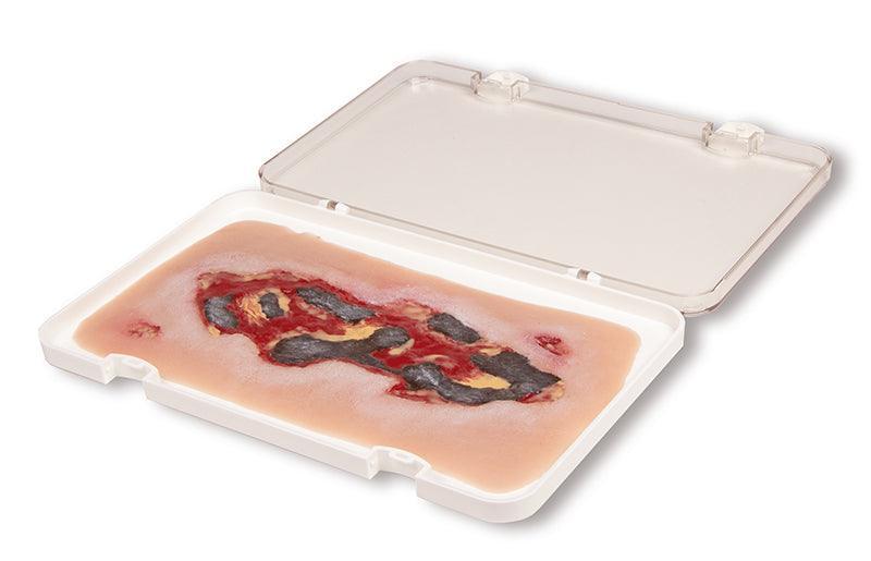 Wundmoulage Ulcus Cruris Arteriosum, groß, Exsudationsphase, PW005A - Notemed Medizintechnik 