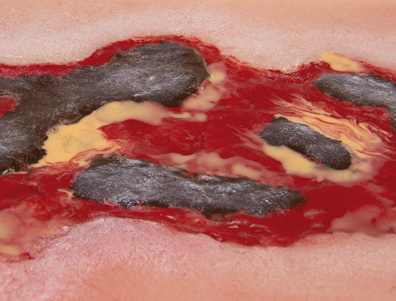 Wundmoulage Ulcus Cruris Arteriosum, groß, Exsudationsphase, PW005A - Notemed Medizintechnik 