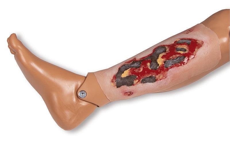 Wundmoulage Ulcus Cruris Arteriosum, groß, Exsudationsphase, PW005A - Notemed Medizintechnik 