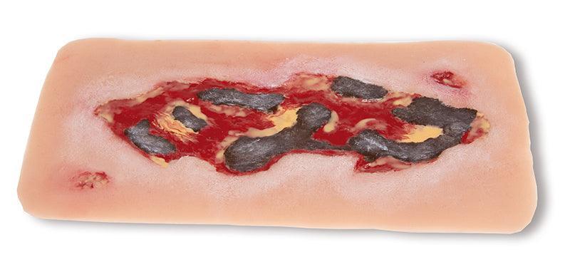Wundmoulage Ulcus Cruris Arteriosum, groß, Exsudationsphase, PW005A - Notemed Medizintechnik 