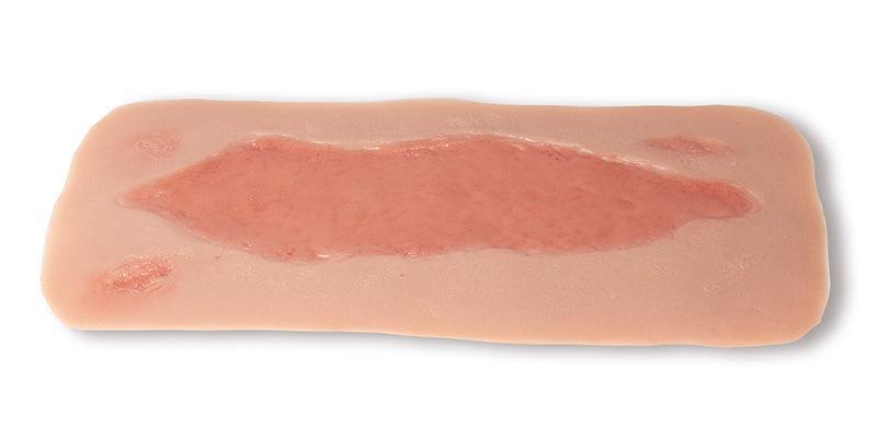 Wundmoulage Ulcus Cruris Arteriosum, groß, Epithelisierungsphase, PW005C - Notemed Medizintechnik 