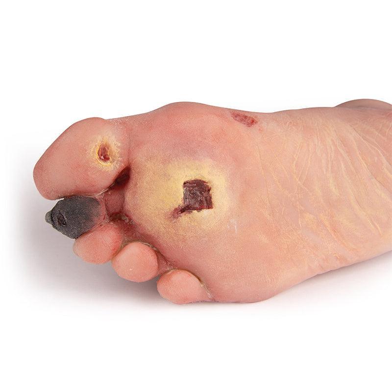 Wundenfuß mit diabetischem Fußsyndrom, PW006 - Notemed Medizintechnik 