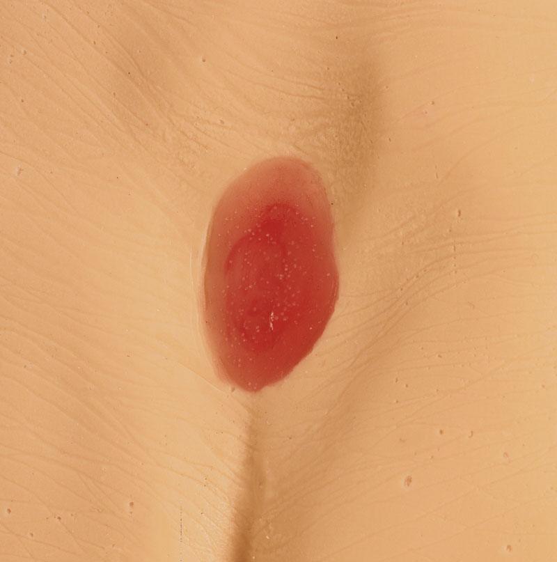 Druckgeschwür / Dekubitus Modelle, R11047 - Notemed Medizintechnik 