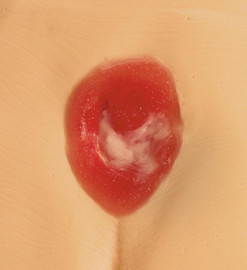 Druckgeschwür / Dekubitus Modelle, R11047 - Notemed Medizintechnik 