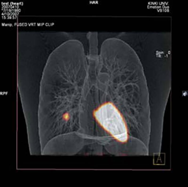 Mediastinum mit linkem Myocard RI Behälter für Radioisotope für R16511, R16511-5 - Notemed Medizintechnik 