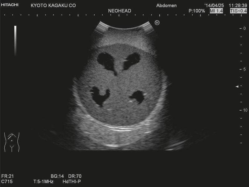 Neonatales Ultraschall-Übungsphantom Kopf mit Hydrocephalus, R16810 - Notemed Medizintechnik 