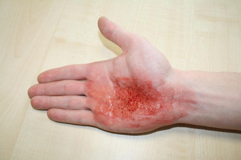 EZ Wounds – Wundensimulation Basic, WS01 - Notemed Medizintechnik 