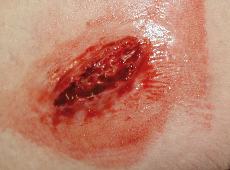 EZ Wounds – Wundensimulation Basic, WS01 - Notemed Medizintechnik 